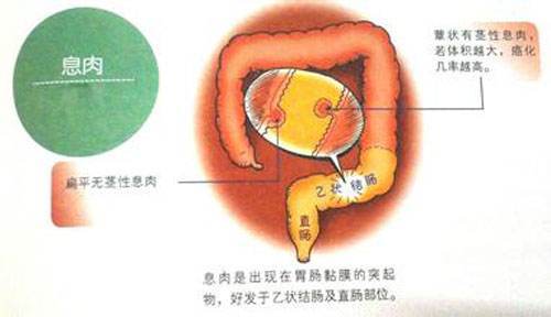 肠息肉可以喝白酒吗，会癌变吗？