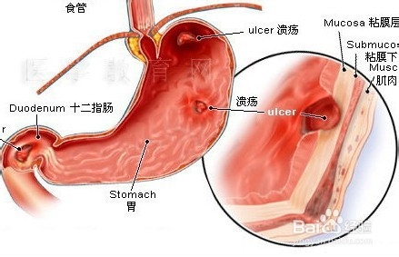 陈皮胃溃疡的人可以喝嘛，陈皮对胃溃疡有好处吗，胃溃疡可以喝陈皮生水吗