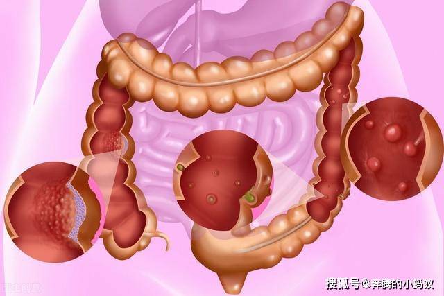 肠息肉术后喝白茶会有影响吗，可能会复发吗？