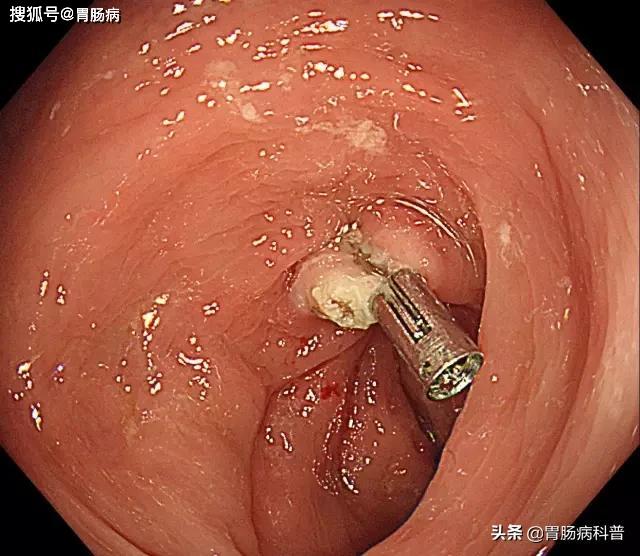 做了肠息肉手术后能喝白茶吗？