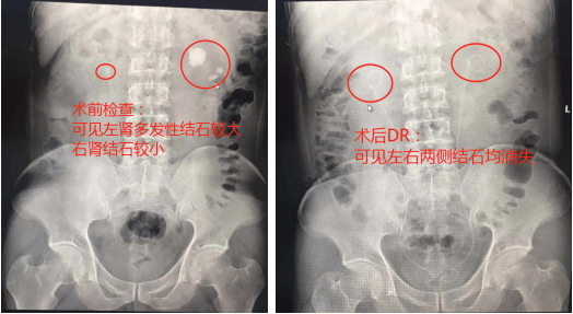 老白茶会导致肾结石吗？女性和男性能喝吗？