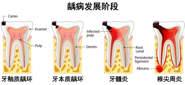 智齿冠周炎能喝白酒吗，女性会疼吗？