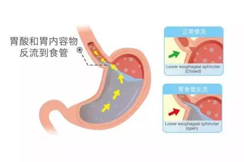 胃食道返流可以喝白茶吗